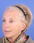 Before Hair Transplant&nbsp;Hair Thinning